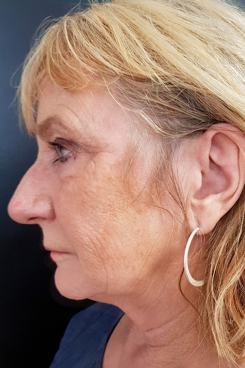 View 3 — before (pre-operative)